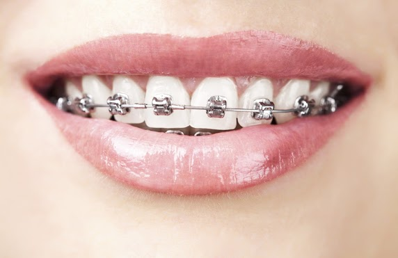This is the image for the news article titled Best Ways To Use Wax For Your Braces